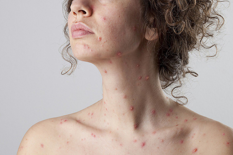 Sốt virus có thể khiến bạn nổi phát ban trên da